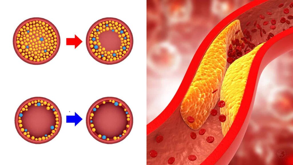 تاثیر مورینگا اولیفرا بر کلسترول بالا 1 20 Things to Do to Reduce High Cholesterol