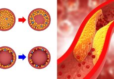 20 Things to Do to Reduce High Cholesterol