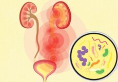 urinary tract infection guide 722x406 1